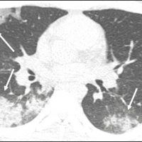 Condensações pulmonares