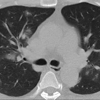 Pneumonia periférica em focos e em Placas