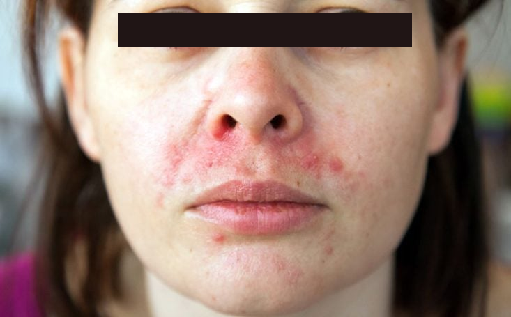 Dermatite perioral com pápulas e pústulas