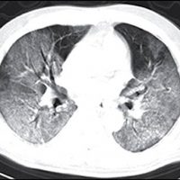 pneumonia em vidro fosco